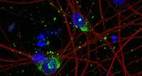 Human Neuron Model Paves the Way for New Alzheimer’s Therapies