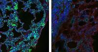 Researchers Identify Protein Sensor that Plays a Role in Lung Fibrosis