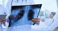 Câncer de pulmão: Sintomas, tratamento e cura