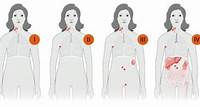 Estadiamentos do linfoma não-Hodgkin e como diagnosticar - Abrale
