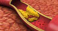 Cholestérol LDL : Interprétation des résultats