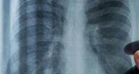 Dois novos casos de câncer de pulmão são diagnosticados no HC de Botucatu semanalmente