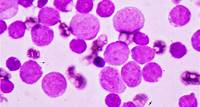 Saúde Leucemia Linfoide Aguda (LLA): o que é, diagnóstico e tratamento Esta forma agressiva de câncer do sangue afeta principalmente células imaturas da linhagem linfocítica