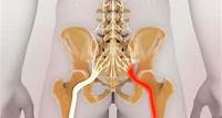 Qué es la ciática La ciática se debe a la irritación del nervio ciático y causa dolor al final de la espalda, que se extiende hacia el glúteo y la pierna y puede durar días.