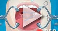 Operate now: Tonsil surgery Walktrough