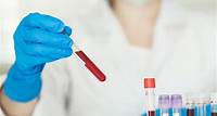 Exame Beta HCG: entenda o resultado do exame de sangue que detecta gravidez | Laboratório Exame
