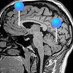 Gehirn 3D-MRT : normale anatomie | e-Anatomy