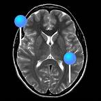 Gehirn Axialschnitt-MRT : normale anatomie | e-Anatomy