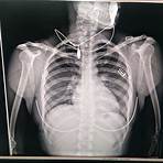 Chest X-Ray Images (Pneumonia)