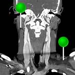 Kopf und Hals CT : normale anatomie | e-Anatomy