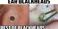 Ear Blackheads - Comedones, Comedo, Blackhead Removal & Pimple Excision