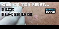 More Back Blackheads: One of my first patients I videotaped has returned!