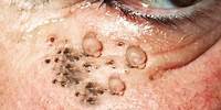 Spreading Blackheads! Dilated Pore of Winer