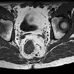 rectal cancer x ray2
