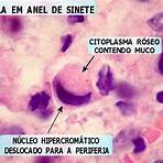 adenocarcinoma gástrico histologia4