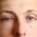 How long does it take to get rid of pink eye?2