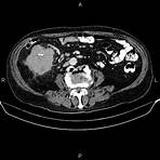 adenocarcinoma in situ intestino4