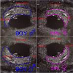 boy or girl from ultrasound3