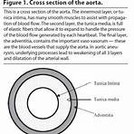 Aneurisma de aorta abdominal wikipedia2