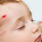 concussion in babies symptoms2
