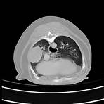 adenocarcinoma pulmão cão raio x1