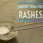 prickly heat rash remedies with baking soda and water1