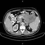 adenocarcinoma gástrico tipo intestinal1