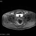 rectal cancer x ray5