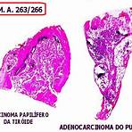 adenocarcinoma de cólon anatpat3