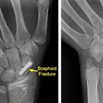 scaphoid fracture5