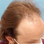 hair implant1