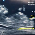 boy or girl from ultrasound4