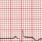 infarto agudo do miocárdio ecg5