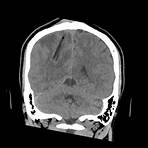 tomografía computarizada cerebral tce1