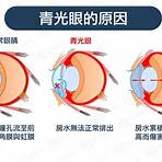 青光眼原因及治療方法3