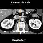 Renal artery wikipedia1