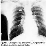 tuberculose pleural imagens4