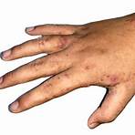 scabies symptoms rash pictures4