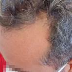 hair implant2