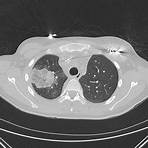 Tromboembolismo pulmonar wikipedia1