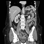 small bowel obstruction internal hernia radiology3