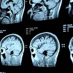 tumor no cérebro imagens5