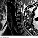 ataxia cerebelar aguda3