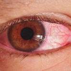 how to get pink eye overnight4