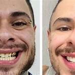 lentes dentes famosos antes e depois1