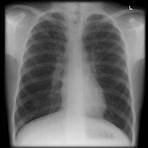 shrinking lung syndrome3
