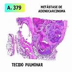 adenocarcinoma de cólon anatpat3