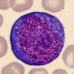 imagens de linfoblastos3
