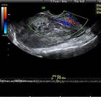 miomatosis uterina clasificación1