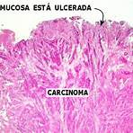 adenocarcinoma gástrico histologia5